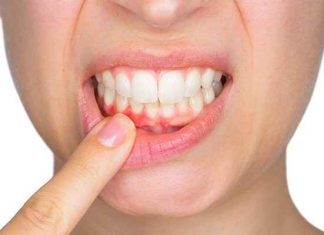 periodontitida serres e vima 11zon