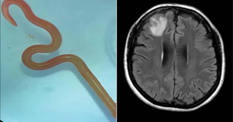 «Θεέ μου, τι είναι αυτό; Κουνιέται!»: Σκουλήκι 8 εκατοστών βρέθηκε στον εγκέφαλο γυναίκας